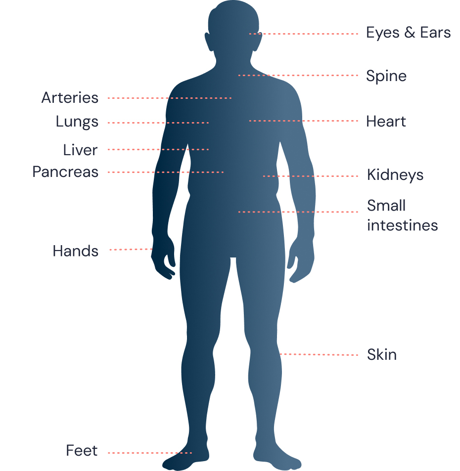 Graphic showing how uncontrolled chronic gout is a systemic disease that may affect multiple organs, with urate deposition and monosodium urate crystals known to accumulate in the eyes, ears, spine, heart, lungs, arteries, liver, pancreas, kidneys, hands, small intestine, skin, feet, and joints throughout the body.