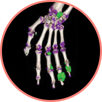 DECT scan of gout patient showing urate crystals remaining in wrist and finger joints during intercritical gout