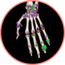 Dual Energy CT (DECT) scan of gout patient revealing urate deposits in the finger joints and wrist