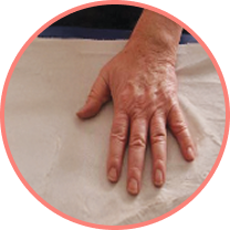 Hand in controlled gout patient